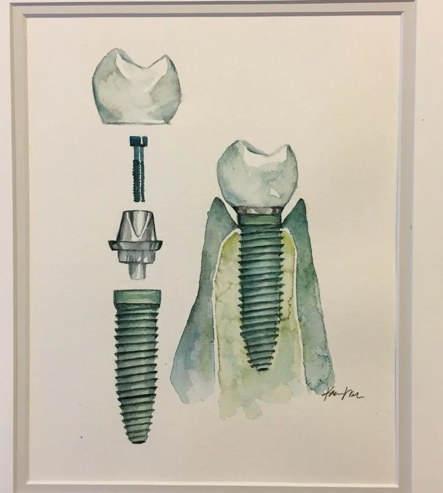 A watercolour of a dental implant, abutment and crown, hanging in the office.