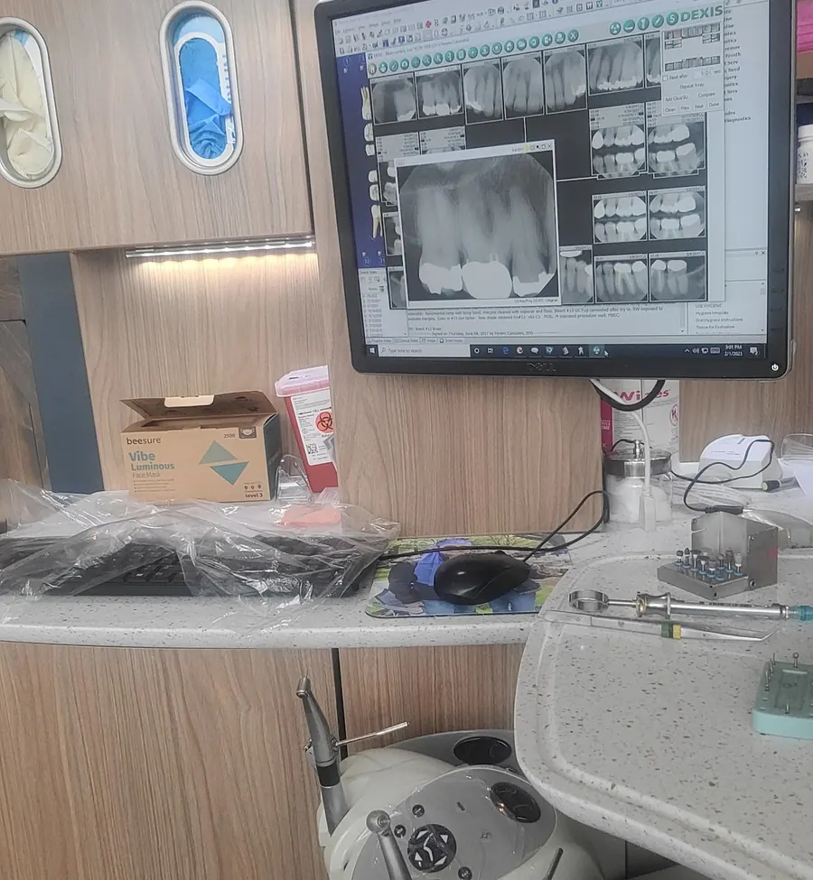 A digital x-ray on the chairside monitor in a Severn River Dental treatment room.